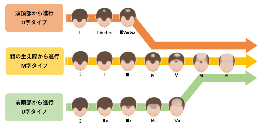 薄毛のタイプ